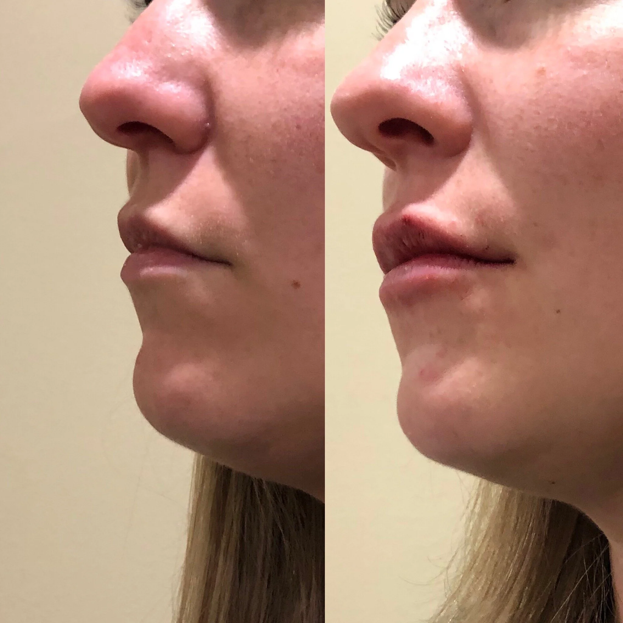  1/2 syringe of lip filler 