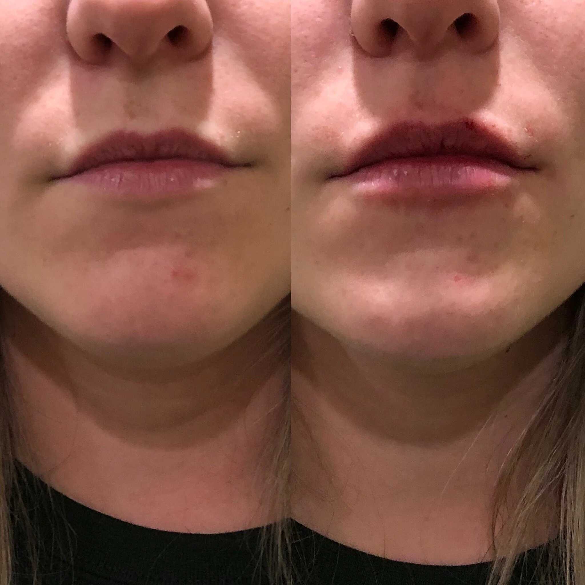  1/2 syringe of lip filler 