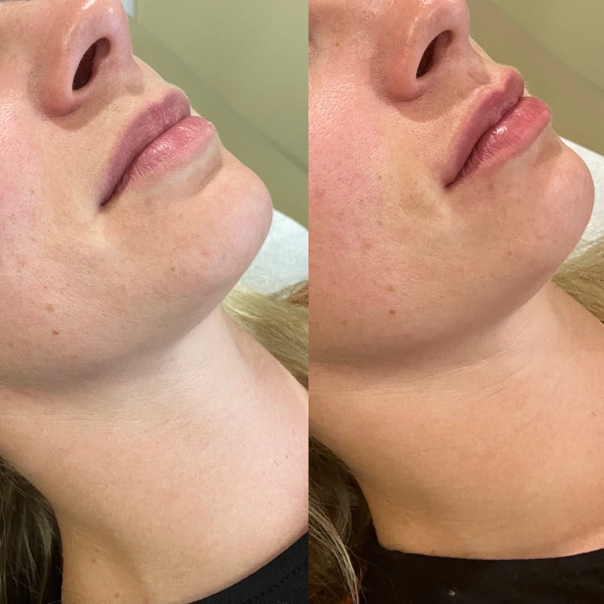 1/2 syringe lip filler