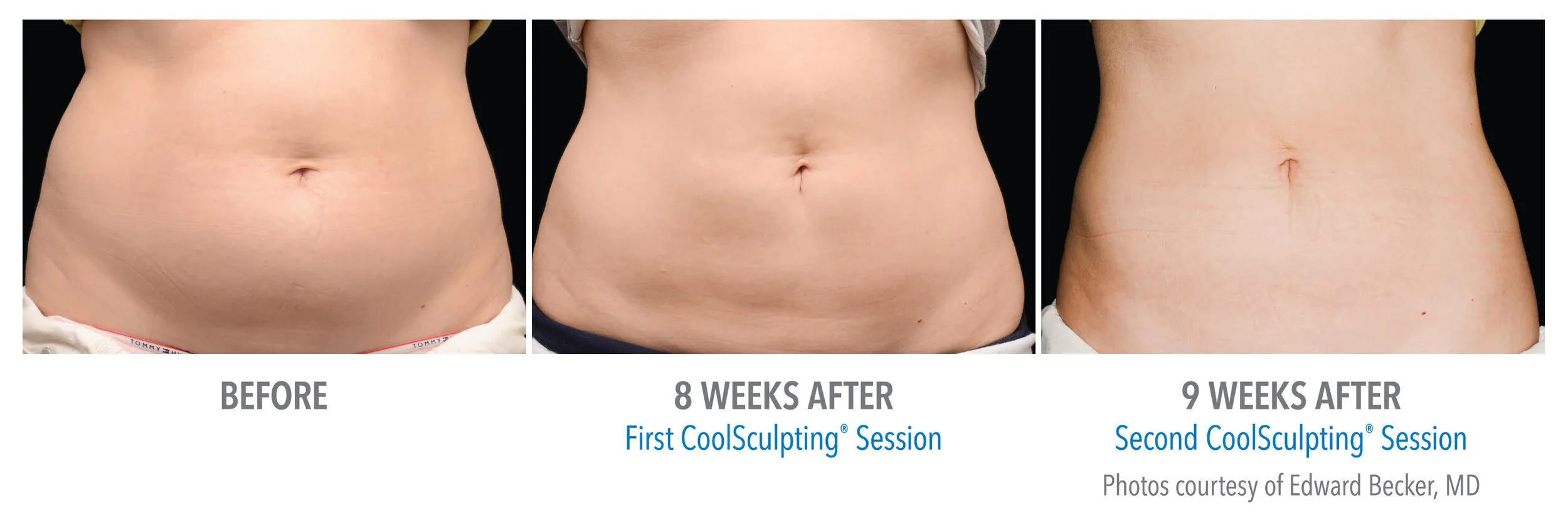 1 Coolsculpting Treatment In Chicago Illinois Contour Medspa 1-coolsculpting-treatment-in-chicago-illinois-contour-medspa