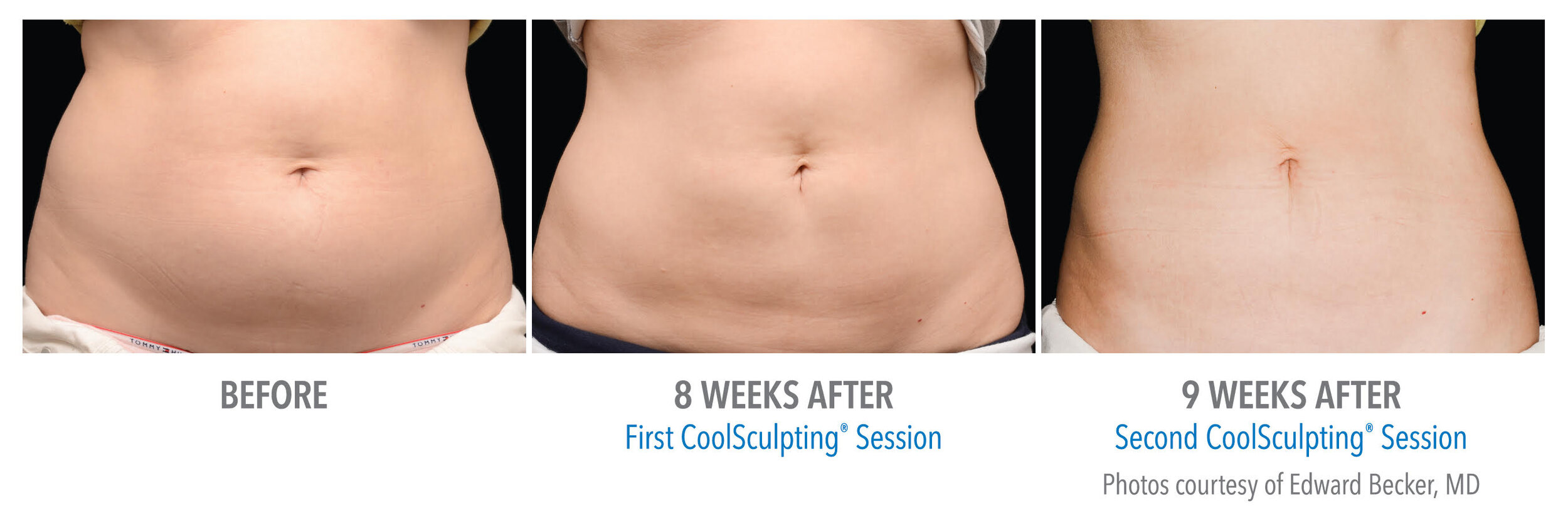1-coolsculpting-treatment-in-chicago-illinois-contour-medspa