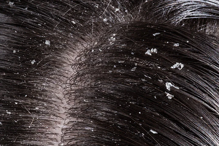 how do i get rid of dandruff and itchy scalp