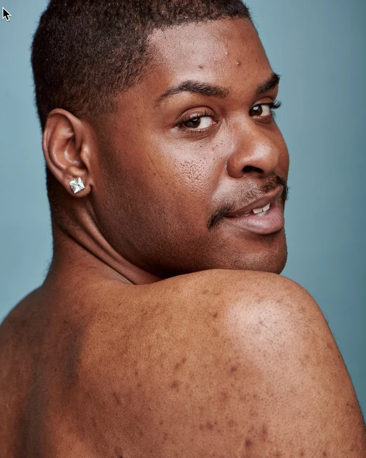 Hyperpigmentation — Medical Secrets — Medical Secrets