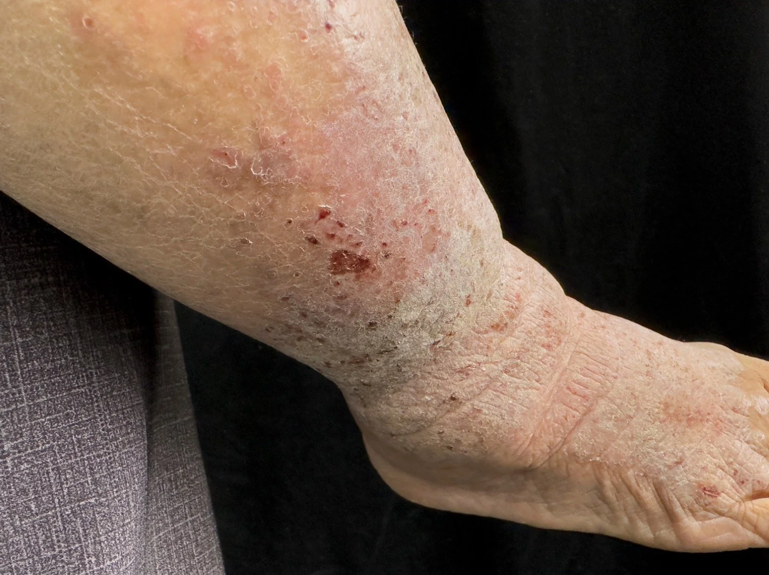 Stasis dermatitis