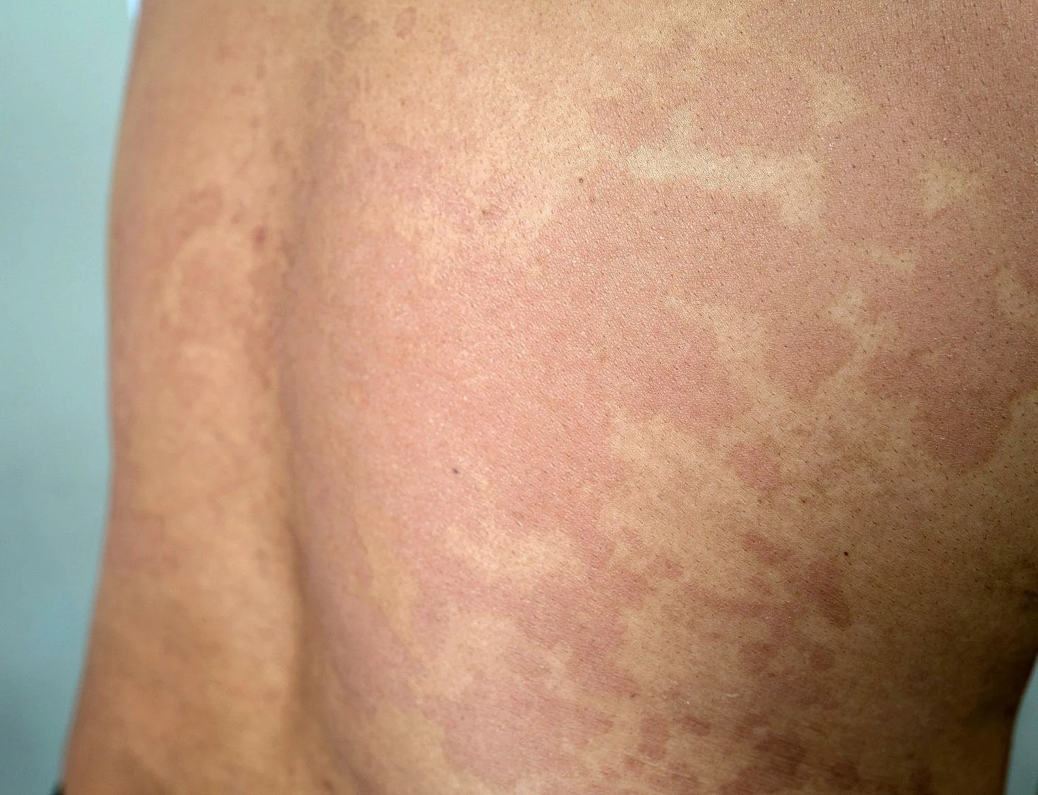 Tinea Versicolor Medical Secrets Tinea Versicolor Medical Secrets
