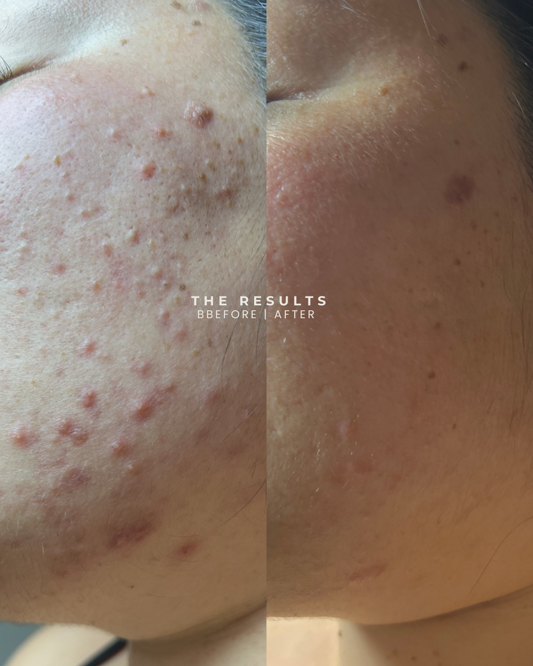 moderate inflamed and non inflmaed acne.zip - 3.PNG