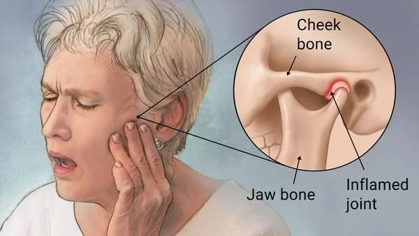 TMJ-disorders.jpeg