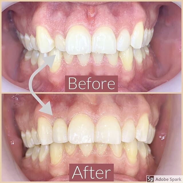 Our patient still had a teeny baby lateral &amp; wanted it to be symmetrical to his adult lateral. We prepped it and added a crown on top. Look at the difference! 🤯
