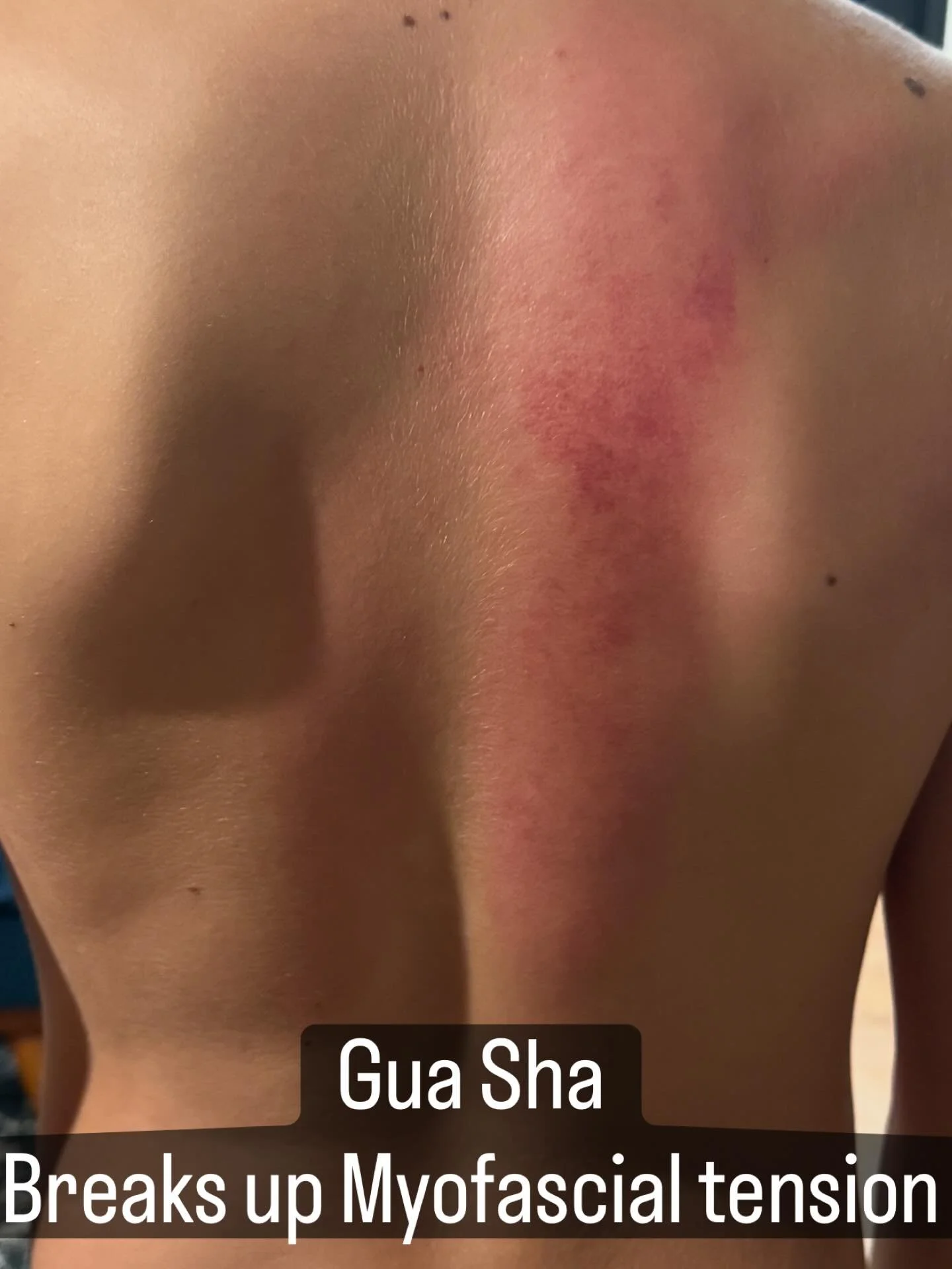 Myofascial magic! When your preteen asks, &ldquo;can you fix my knots, mom?&rdquo; GUA SHA to the rescue! #pediatricacupuncture #myofascialtherapy #guasha