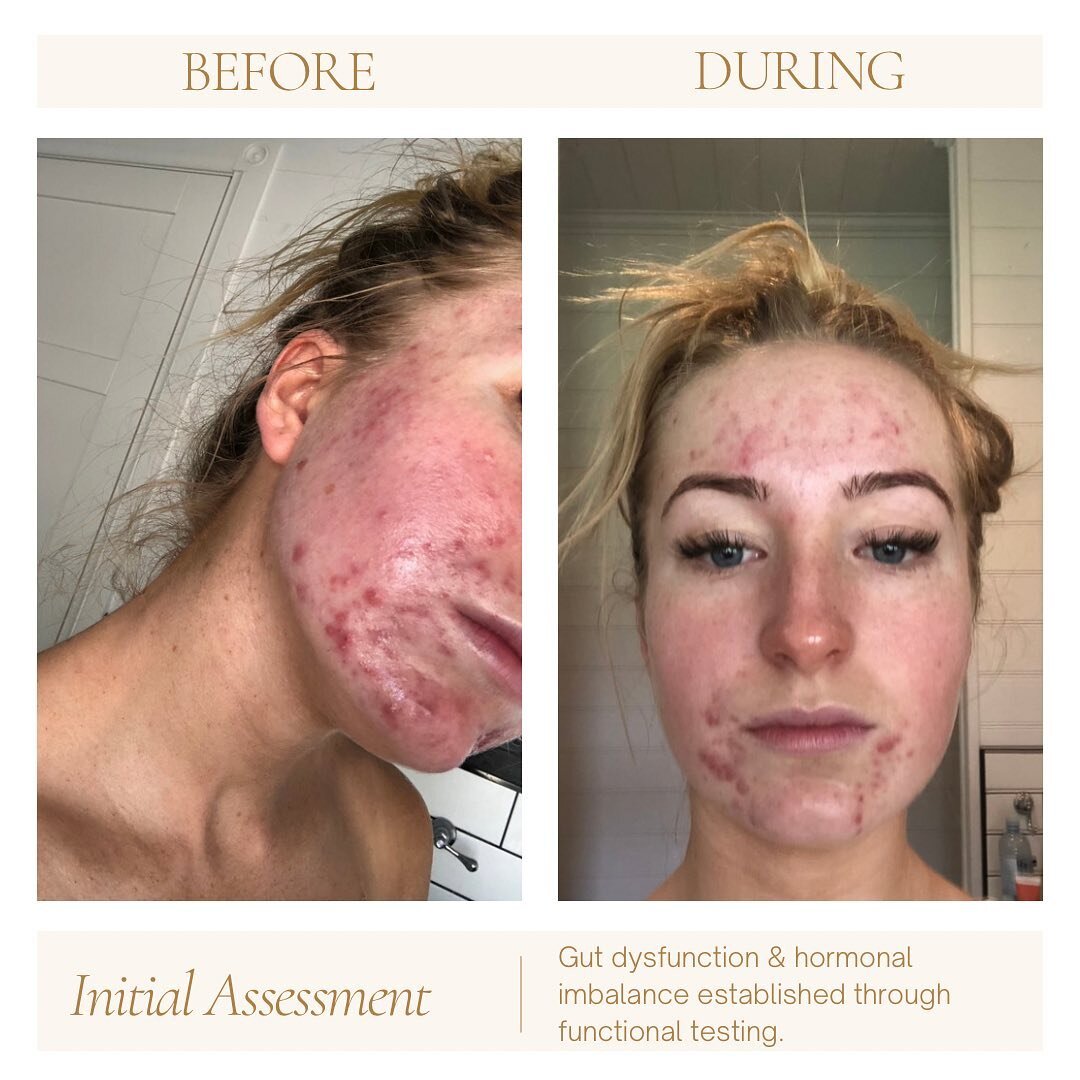 Beautiful skin is an inside job ✨
When we find the root cause for unhappy skin, we can find the fix. 
For this beautiful patient, it was bacterial overgrowth in the gut and inefficient clearance of oestrogen via the liver (assessed through a Comprehe