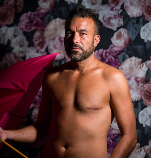 Mikel, un "Papa Kool" face à sa double mastectomie. 