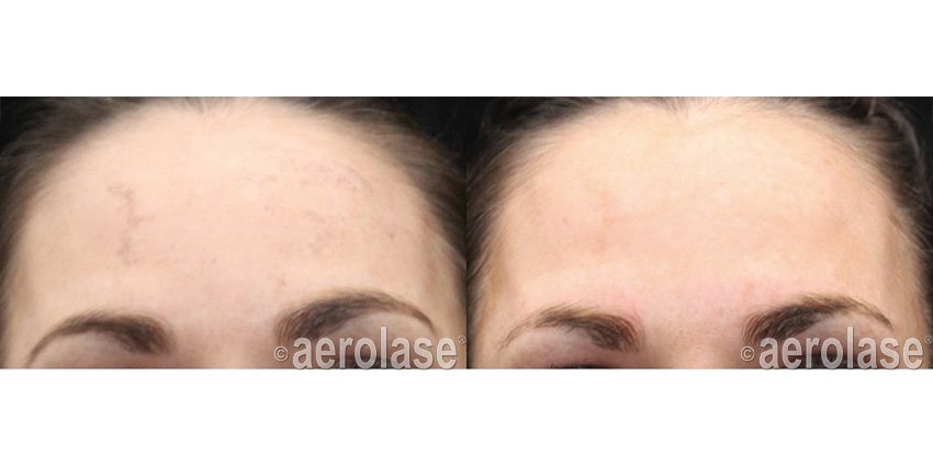 NeoSkin Melasma - After 1 Treatment combined with Salicylic Peel - Suneel Chilukuri MD.jpg