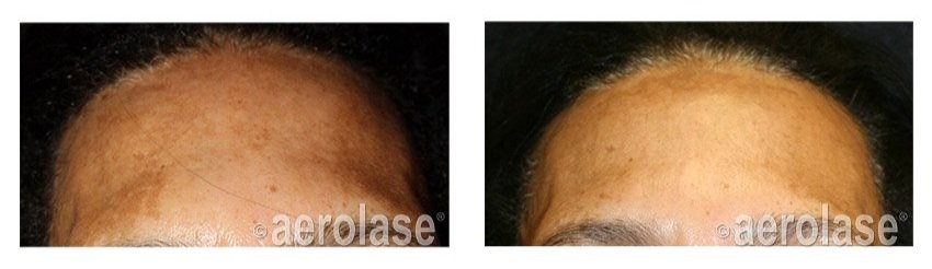 NeoSkin+Melasma+-+After+1+Treatment+combined+with+TCA+Peel+-+Cheryl+Burgess+MD.jpg
