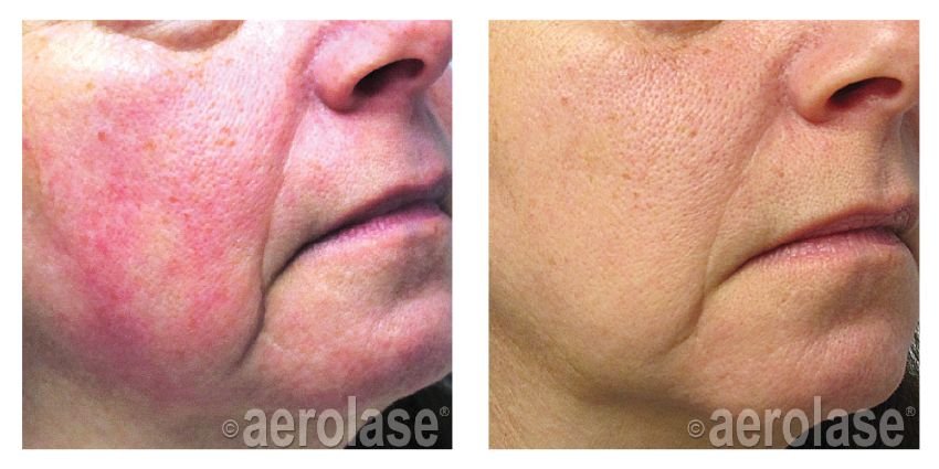 NeoSkin Rosacea - After 1 Treatment - Yelena Kipervas DO.jpg