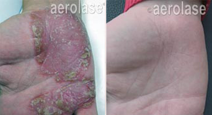 Psoriasis1 - Pair.png