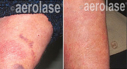 Psoriasis2 - Pair.png