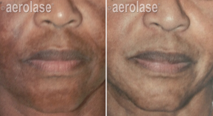 Melasma2 - Pair.png