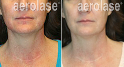 Rosacea3 - Pair.png