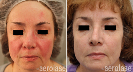 Rosacea2 - Pair.png