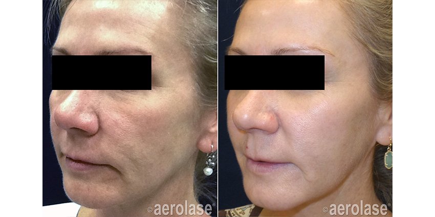 NeoSkin Rejuvenation - After 4 Treatments - Kevin Pinski MD.jpg