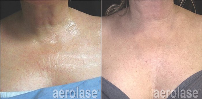 NeoSkin Rejuvenation - After 4 Treatments - Jason Emer MD.jpg