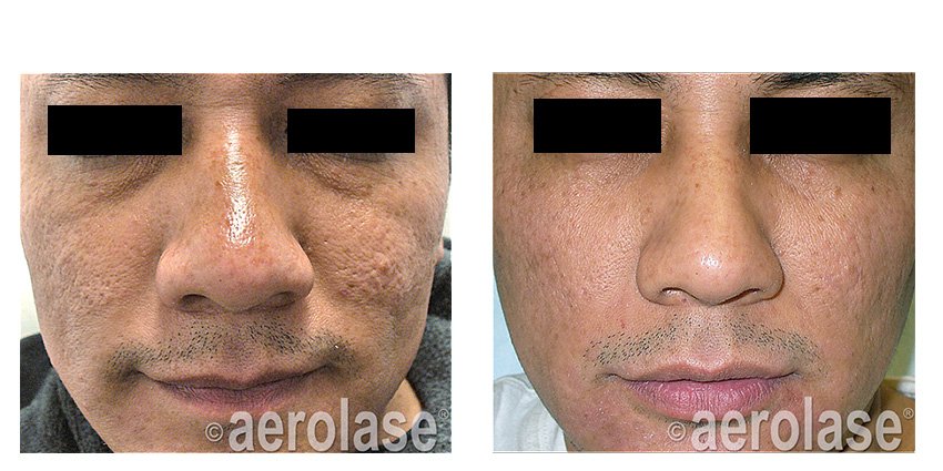 NeoSkin Rejuvenation - After 7 Treatments - Fran Cook-Bolden MD.jpg