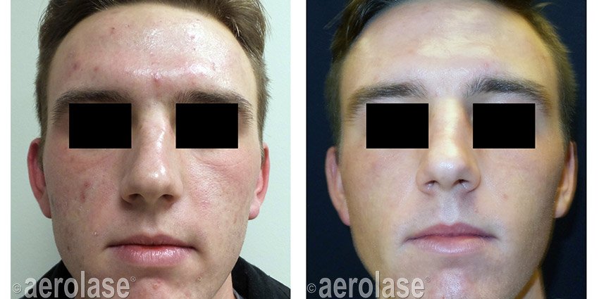 NeoClear Acne - After 3 Treatments - Kevin Pinski MD.jpg
