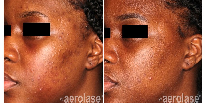 NeoClear Acne - After 4 Treatments - Michelle Henry MD.jpg