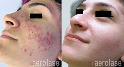 Acne1 - Pair.png