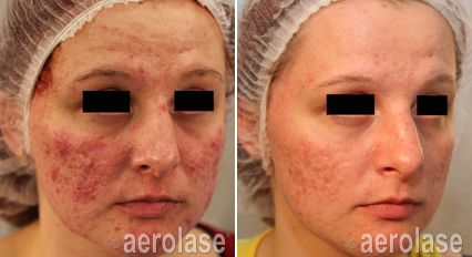 Acne2 - Pair.png