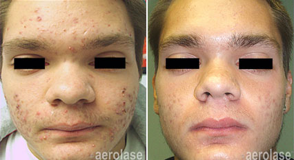 Acne3 - Pair.png