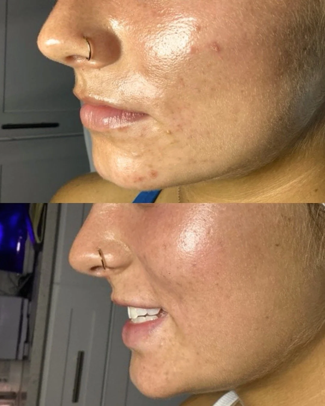 Comparison of skin before and after treatment, showing clearer skin and reduced blemishes in the second image