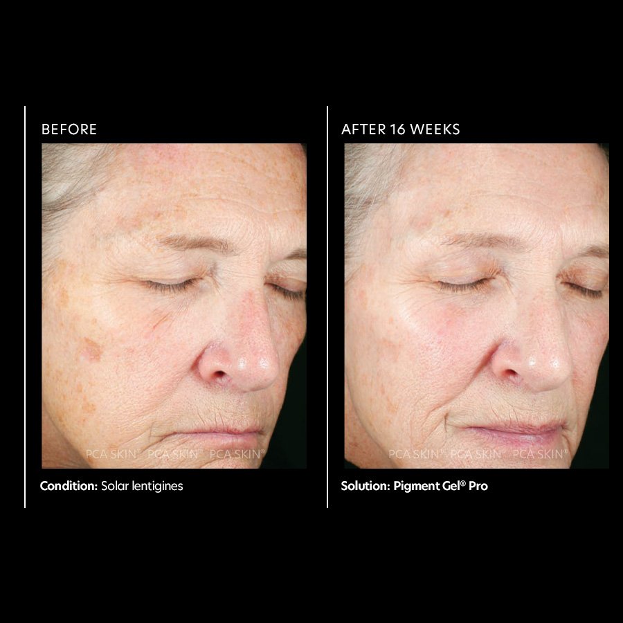 pigment pro gel B and A (fair skin).jpeg