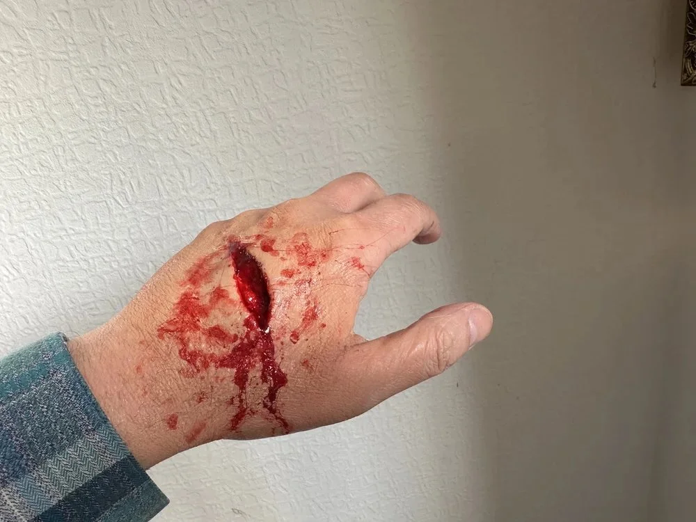 hand injury 2.jpg