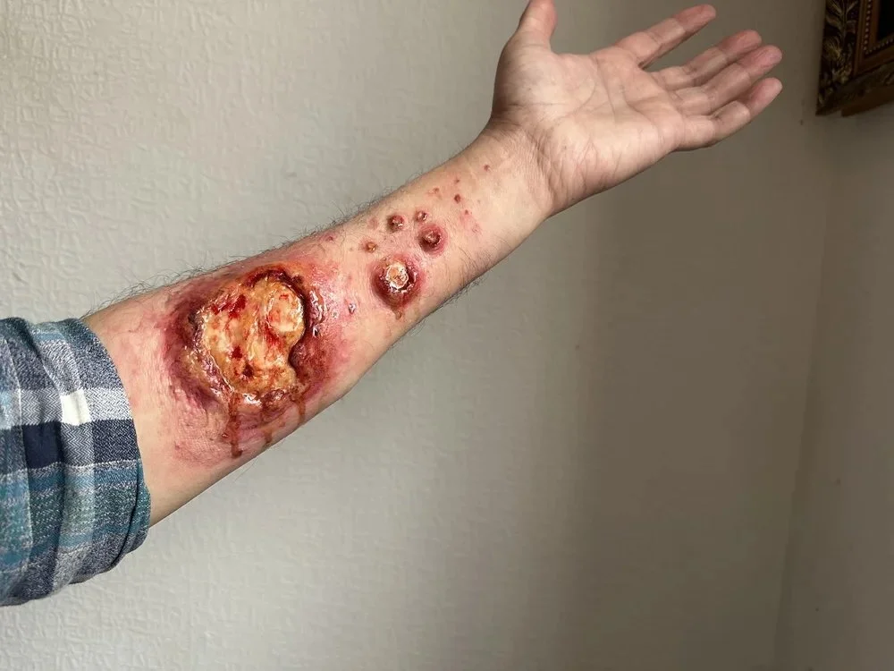 Arm infection 1.jpg