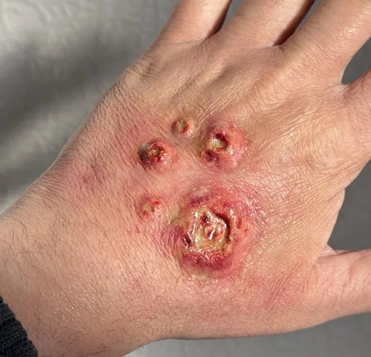 hand infection 1.jpg