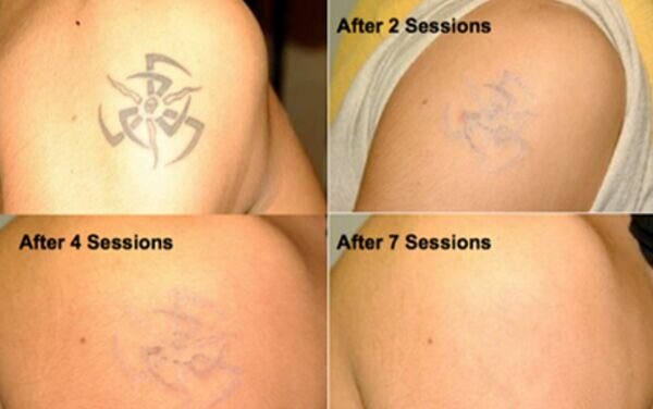Vol 2 Best Of 2021 Before  After Tattoo Removal Results  Removery