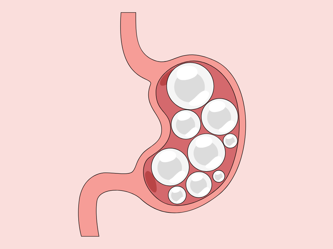 Why Am I Bloated? Understanding the Real Causes of Bloating and Distension
