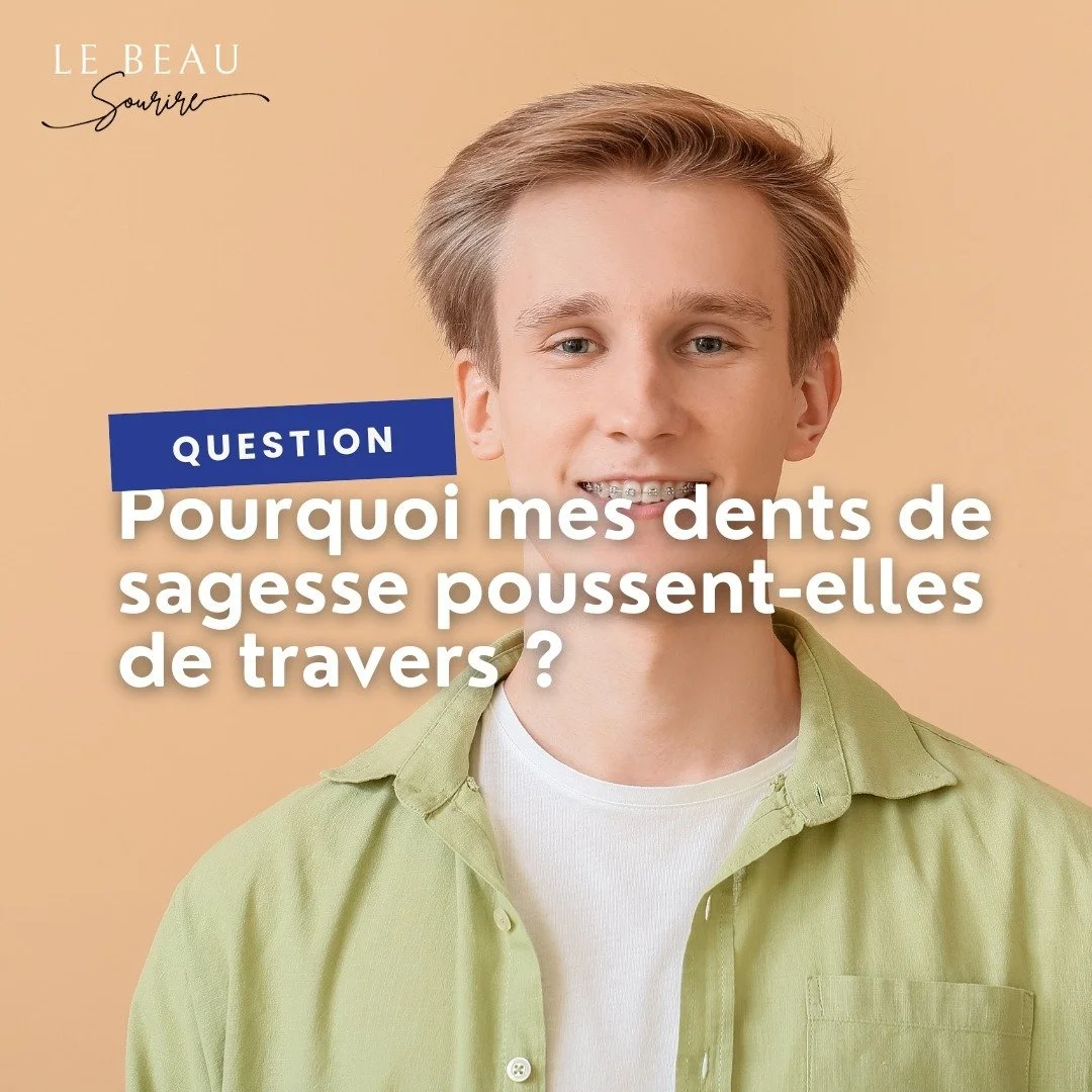 Pourquoi mes dents de sagesse poussent-elles de travers ? 🦷
Les dents de sagesse sont les dernières à faire leur apparition, souvent entre 17 et 25 ans, quand la bouche est déjà bien occupée. Par manque de place,
