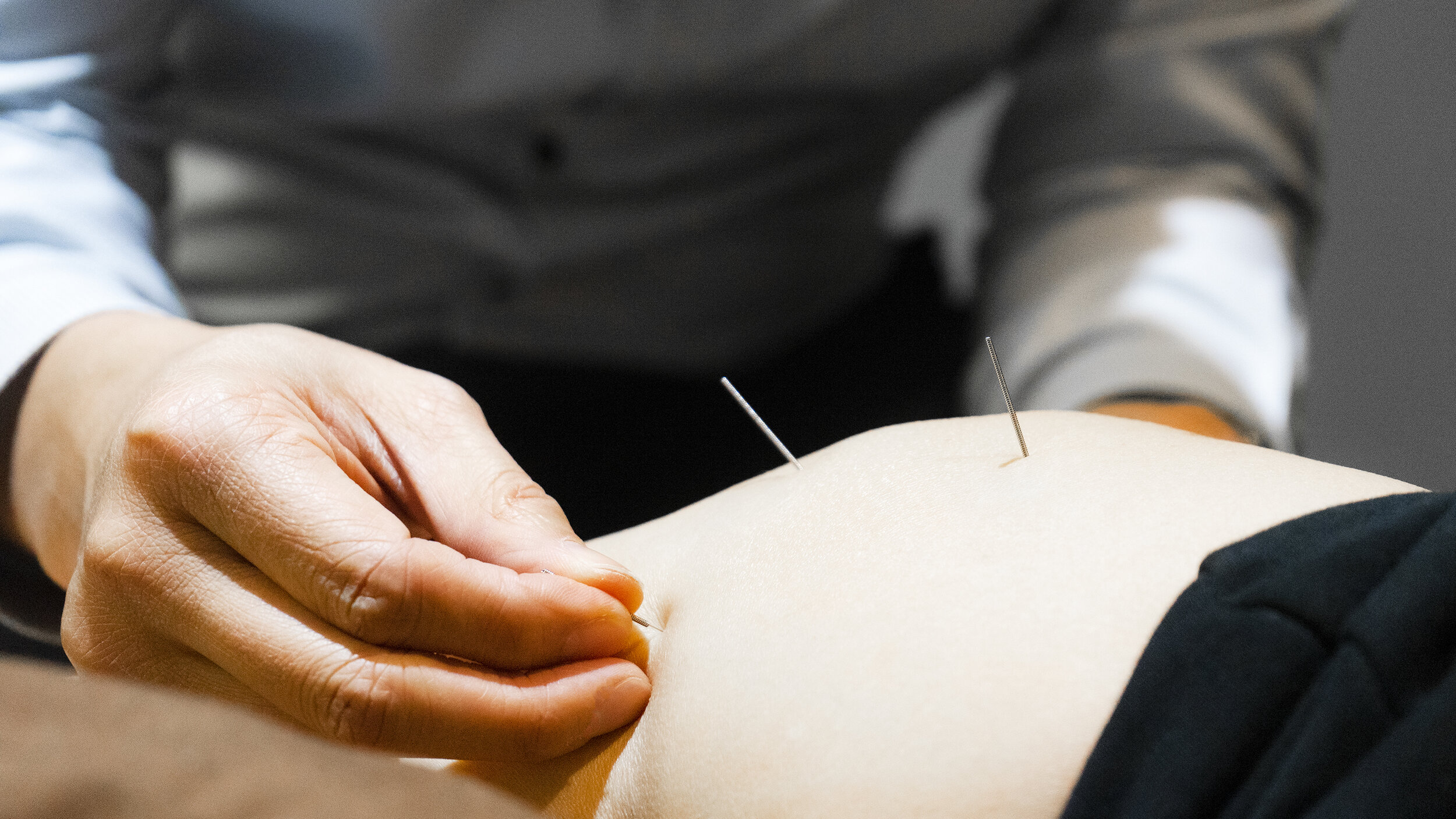Acupuncture — First Markham Physiotherapy & Rehabilitation