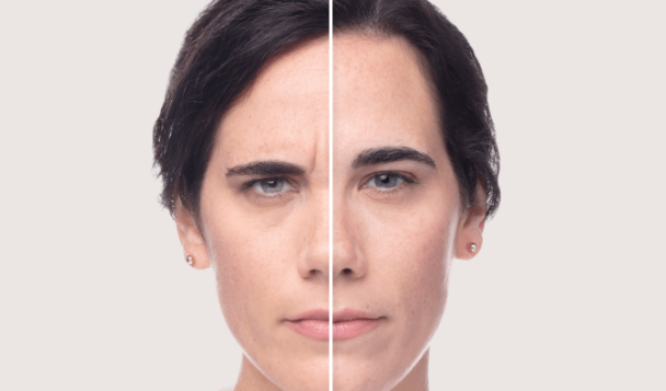 before and after_dysport 6.PNG