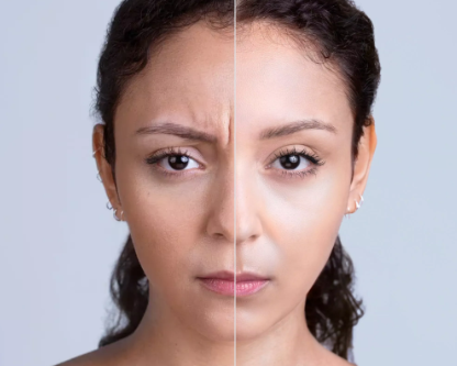 before and after_xeomin 3.PNG