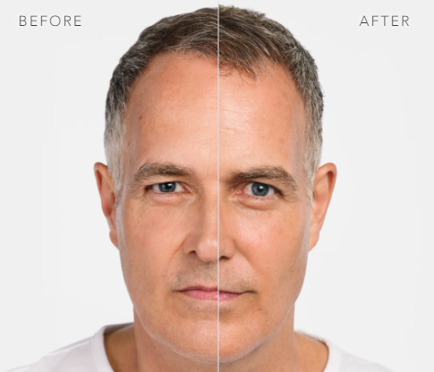 before and after_radiesse 1.PNG