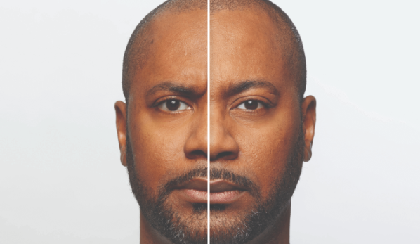 before and after_dysport 3.PNG