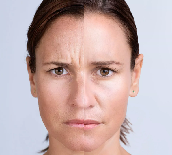 before and after_xeomin 1.PNG