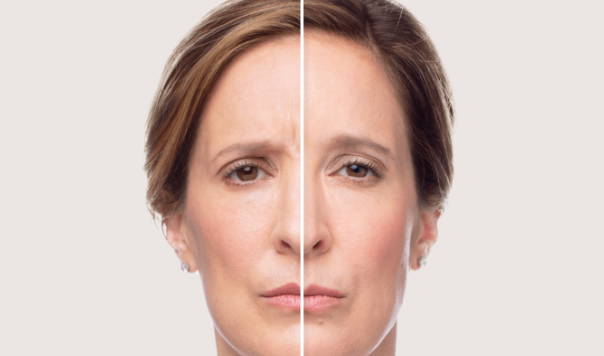 before and after_dysport 5.PNG