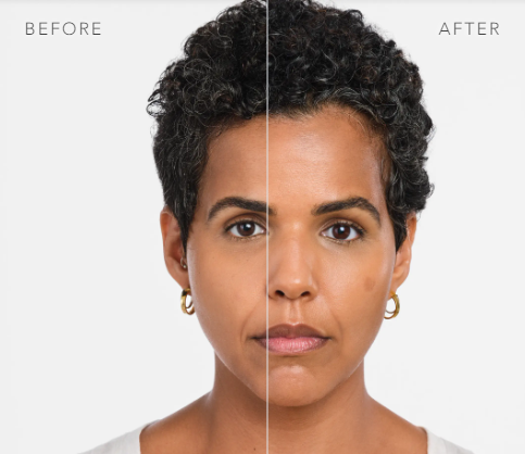 before and after_radiesse 2.PNG