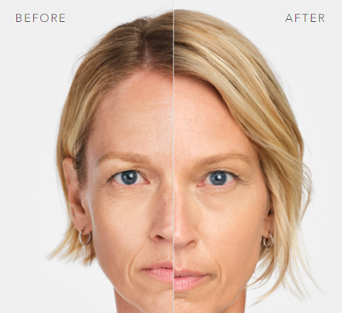 before and after_radiesse 3.PNG