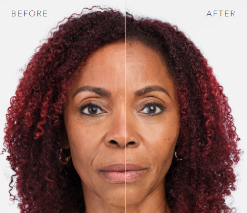 before and after_radiesse 4.PNG