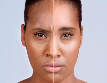 before and after_xeomin 2.PNG